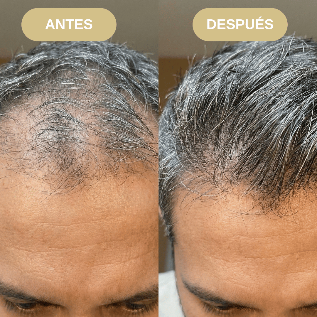 Shampoo Anticaida y Activador Folicular con Extracto de Romero, Minoxidil y Extracto de Ortiga