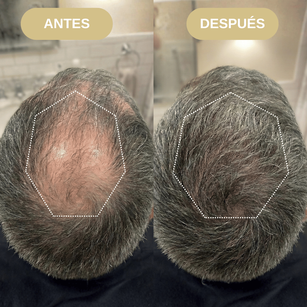 Shampoo Anticaida y Activador Folicular con Extracto de Romero, Minoxidil y Extracto de Ortiga
