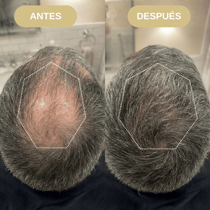 Shampoo Anticaida y Activador Folicular con Extracto de Romero, Minoxidil y Extracto de Ortiga